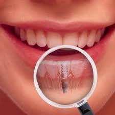 Implantologia dentale