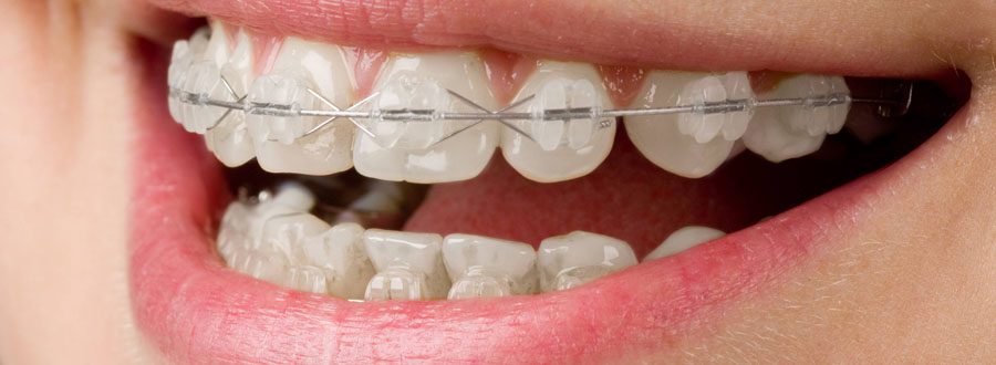 Ortodonzia e invisalign